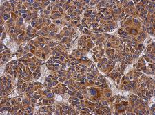 CCDC50 Antibody - IHC of paraffin-embedded Hepatoma, using Ymer antibody at 1:500 dilution.