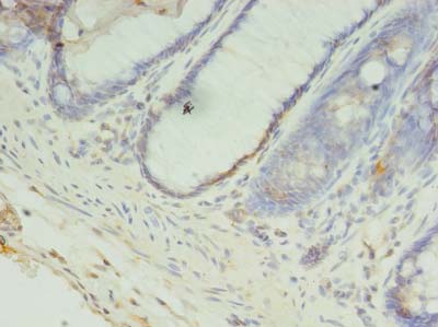 CCDC57 Antibody - Immunohistochemistry of paraffin-embedded human colon cancer using antibody at dilution of 1:100.