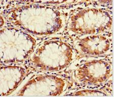 CCDC59 Antibody - Immunohistochemistry of paraffin-embedded human colon cancer using CCDC59 Antibody at dilution of 1:100
