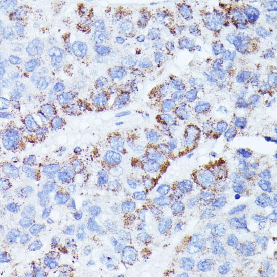 CCDC6 Antibody - Immunohistochemistry of paraffin-embedded Human liver cancer using CCDC6 Polyclonal Antibody at dilution of 1:100 (40x lens).