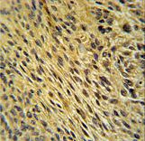 CCDC62 Antibody - CCDC62 Antibody immunohistochemistry of formalin-fixed and paraffin-embedded human lung carcinoma followed by peroxidase-conjugated secondary antibody and DAB staining.