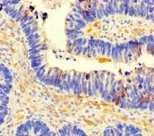 CCDC66 Antibody - Immunohistochemistry of paraffin-embedded human ovarian cancer using CCDC66 Antibody at dilution of 1:100