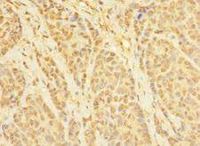 CCDC79 Antibody - Immunohistochemistry of paraffin-embedded human ovarian cancer using TERB1 Antibody at dilution of 1:100