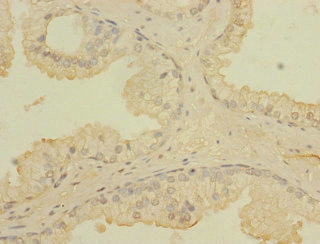 CCDC79 Antibody - Immunohistochemistry of paraffin-embedded human prostate cancer using TERB1 Antibody at dilution of 1:100