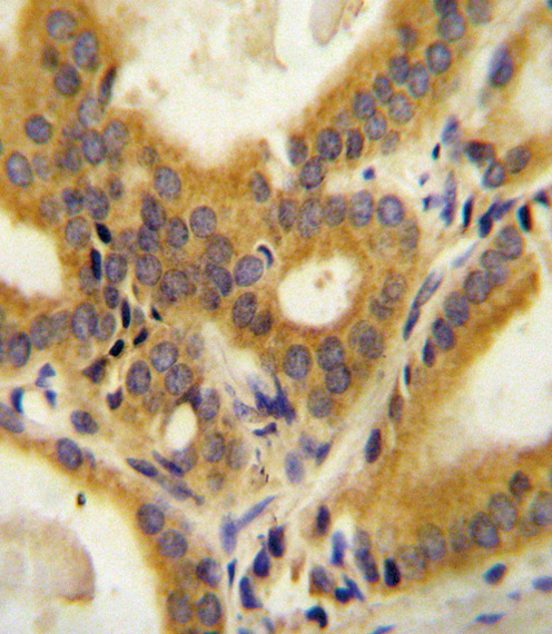 CCDC85C Antibody - CC85C Antibody immunohistochemistry of formalin-fixed and paraffin-embedded human prostate carcinoma followed by peroxidase-conjugated secondary antibody and DAB staining.