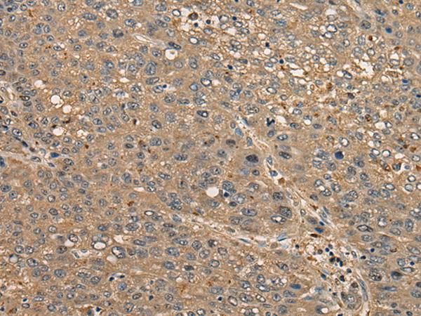 CCDC85C Antibody - Immunohistochemistry of paraffin-embedded Human liver cancer tissue  using CCDC85C Polyclonal Antibody at dilution of 1:30(×200)