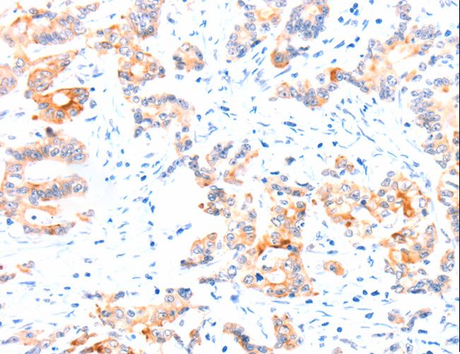 CCDC88A / GIV / Girdin Antibody - Immunohistochemistry of paraffin-embedded Human colon cancer using CCDC88A Polyclonal Antibody at dilution of 1:50.