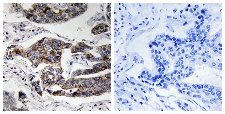 CCDC88A / GIV / Girdin Antibody - Immunohistochemistry analysis of paraffin-embedded human breast carcinoma, using Girdin (Phospho-Ser1417) Antibody. The picture on the right is blocked with the phospho peptide.