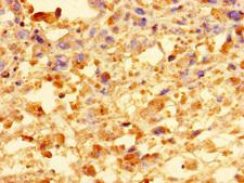 CCDC91 Antibody - Immunohistochemistry of paraffin-embedded human melanoma using CCDC91 Antibody at dilution of 1:100