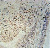 CCDC92 Antibody - CCD92 Antibody immunohistochemistry of formalin-fixed and paraffin-embedded human colon carcinoma followed by peroxidase-conjugated secondary antibody and DAB staining.
