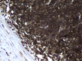CCDC93 Antibody - IHC of paraffin-embedded Human lymphoma tissue using anti-CCDC93 mouse monoclonal antibody.