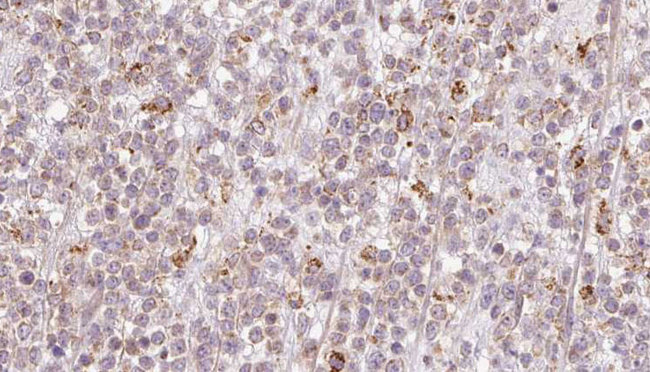 CCDC93 Antibody - 1:100 staining human lymph carcinoma tissue by IHC-P. The sample was formaldehyde fixed and a heat mediated antigen retrieval step in citrate buffer was performed. The sample was then blocked and incubated with the antibody for 1.5 hours at 22°C. An HRP conjugated goat anti-rabbit antibody was used as the secondary.