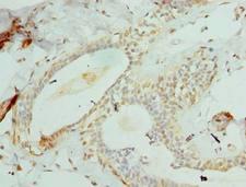 CCDC97 Antibody - Immunohistochemistry of paraffin-embedded human breast cancer using antibody at dilution of 1:100.