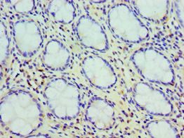 CCK / Cholecystokinin Antibody - Immunohistochemistry of paraffin-embedded human colon cancer tissue using antibody at 1:100 dilution.