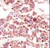 CCK4 / PTK7 Antibody - Formalin-fixed and paraffin-embedded human cancer tissue reacted with the primary antibody, which was peroxidase-conjugated to the secondary antibody, followed by DAB staining. This data demonstrates the use of this antibody for immunohistochemistry; clinical relevance has not been evaluated. BC = breast carcinoma; HC = hepatocarcinoma.