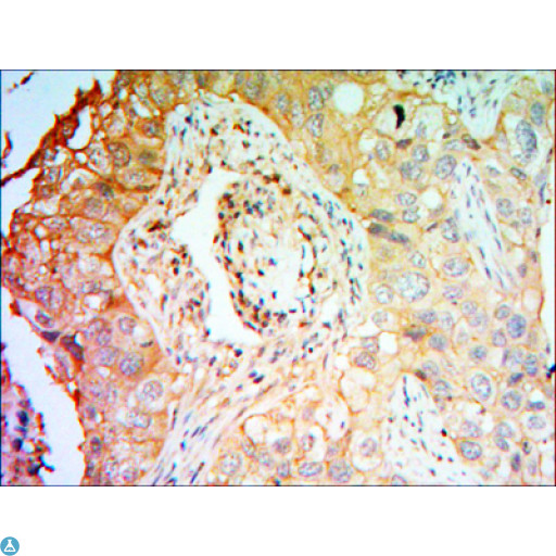 CCK4 / PTK7 Antibody - Immunohistochemistry (IHC) analysis of paraffin-embedded Lung Cancer Tissues with DAB staining using CCK-4 Monoclonal Antibody.