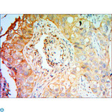CCK4 / PTK7 Antibody - Immunohistochemistry (IHC) analysis of paraffin-embedded Lung Cancer Tissues with DAB staining using CCK-4 Monoclonal Antibody.