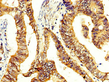 CCKBR / Cckb Antibody - Immunohistochemistry image at a dilution of 1:400 and staining in paraffin-embedded human colon cancer performed on a Leica BondTM system. After dewaxing and hydration, antigen retrieval was mediated by high pressure in a citrate buffer (pH 6.0) . Section was blocked with 10% normal goat serum 30min at RT. Then primary antibody (1% BSA) was incubated at 4 °C overnight. The primary is detected by a biotinylated secondary antibody and visualized using an HRP conjugated SP system.