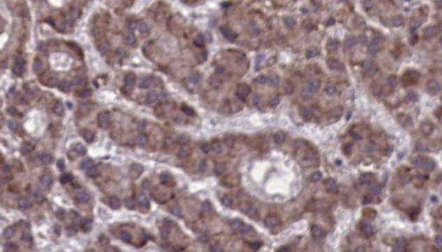 CCKBR / Cckb Antibody - 1:100 staining human liver carcinoma tissues by IHC-P. The sample was formaldehyde fixed and a heat mediated antigen retrieval step in citrate buffer was performed. The sample was then blocked and incubated with the antibody for 1.5 hours at 22°C. An HRP conjugated goat anti-rabbit antibody was used as the secondary.