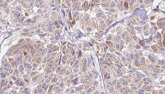 CCL11 / Eotaxin Antibody - 1:100 staining human Melanoma tissue by IHC-P. The sample was formaldehyde fixed and a heat mediated antigen retrieval step in citrate buffer was performed. The sample was then blocked and incubated with the antibody for 1.5 hours at 22°C. An HRP conjugated goat anti-rabbit antibody was used as the secondary.