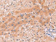 CCL13 / MCP4 Antibody - Immunohistochemistry of paraffin-embedded Human liver cancer tissue  using CCL13 Polyclonal Antibody at dilution of 1:90(×200)