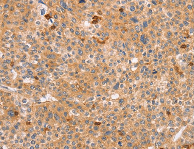CCL16 / LEC Antibody - Immunohistochemistry of paraffin-embedded Human liver cancer using CCL16 Polyclonal Antibody at dilution of 1:60.
