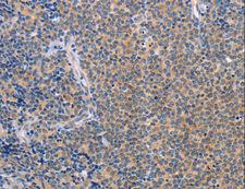CCL16 / LEC Antibody - Immunohistochemistry of paraffin-embedded Human Lymphoma using CCL16 Polyclonal Antibody at dilution of 1:50.