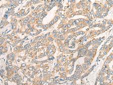 CCL16 / LEC Antibody - Immunohistochemistry of paraffin-embedded Human liver cancer tissue  using CCL16 Polyclonal Antibody at dilution of 1:45(×200)