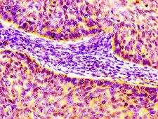 CCL17 / TARC Antibody - Immunohistochemistry image of paraffin-embedded human cervical cancer at a dilution of 1:100