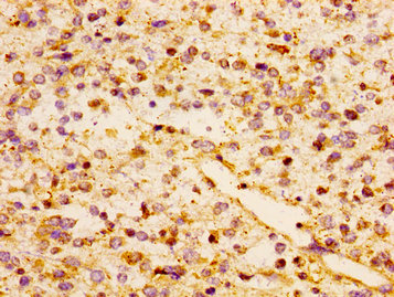 CCL17 / TARC Antibody - Immunohistochemistry image of paraffin-embedded human glioma cancer at a dilution of 1:100