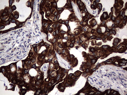 CCL19 / MIP3-Beta Antibody - Immunohistochemical staining of paraffin-embedded Carcinoma of Human lung tissue using anti-CCL19 mouse monoclonal antibody. (Heat-induced epitope retrieval by 1 mM EDTA in 10mM Tris, pH8.5, 120C for 3min,