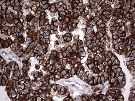 CCL19 / MIP3-Beta Antibody - Immunohistochemical staining of paraffin-embedded Adenocarcinoma of Human ovary tissue using anti-CCL19 mouse monoclonal antibody. (Heat-induced epitope retrieval by 1 mM EDTA in 10mM Tris, pH8.5, 120C for 3min,