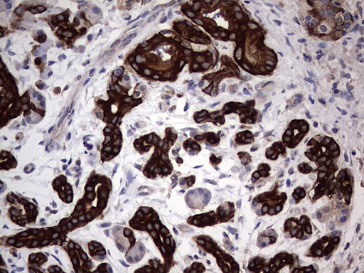 CCL19 / MIP3-Beta Antibody - Immunohistochemical staining of paraffin-embedded Carcinoma of Human pancreas tissue using anti-CCL19 mouse monoclonal antibody. (Heat-induced epitope retrieval by 1 mM EDTA in 10mM Tris, pH8.5, 120C for 3min,