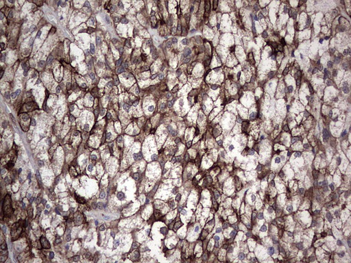 CCL19 / MIP3-Beta Antibody - Immunohistochemical staining of paraffin-embedded Carcinoma of Human thyroid tissue using anti-CCL19 mouse monoclonal antibody. (Heat-induced epitope retrieval by 1 mM EDTA in 10mM Tris, pH8.5, 120C for 3min,