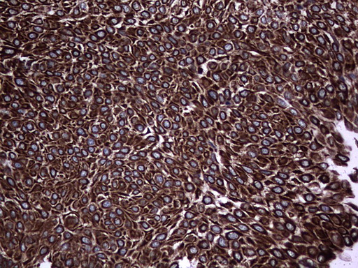 CCL19 / MIP3-Beta Antibody - Immunohistochemical staining of paraffin-embedded Carcinoma of Human bladder tissue using anti-CCL19 mouse monoclonal antibody. (Heat-induced epitope retrieval by 1 mM EDTA in 10mM Tris, pH8.5, 120C for 3min,