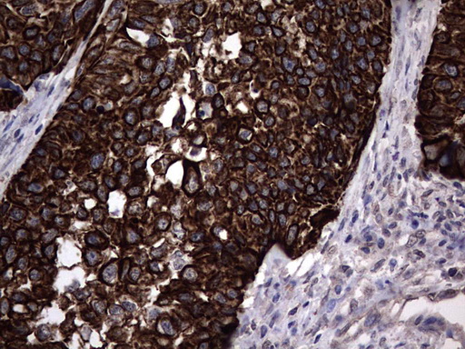 CCL19 / MIP3-Beta Antibody - Immunohistochemical staining of paraffin-embedded Carcinoma of Human kidney tissue using anti-CCL19 mouse monoclonal antibody. (Heat-induced epitope retrieval by 1 mM EDTA in 10mM Tris, pH8.5, 120C for 3min,
