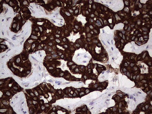 CCL19 / MIP3-Beta Antibody - IHC of paraffin-embedded Carcinoma of Human liver tissue using anti-CCL19 mouse monoclonal antibody. (Heat-induced epitope retrieval by 1 mM EDTA in 10mM Tris, pH8.5, 120°C for 3min).