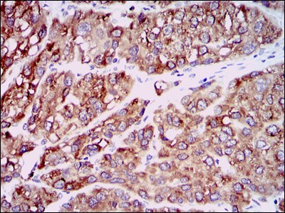 CCL2 / MCP1 Antibody - Immunohistochemistry-Paraffin: MCP1 Antibody (2D8) - Immunohistochemical analysis of paraffin-embedded liver cancer tissues using MCP1 mouse mAb with DAB staining.  This image was taken for the unconjugated form of this product. Other forms have not been tested.