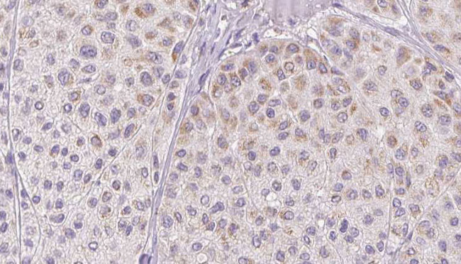 CCL2 / MCP1 Antibody - 1:100 staining human Melanoma tissue by IHC-P. The sample was formaldehyde fixed and a heat mediated antigen retrieval step in citrate buffer was performed. The sample was then blocked and incubated with the antibody for 1.5 hours at 22°C. An HRP conjugated goat anti-rabbit antibody was used as the secondary.