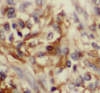 CCL20 / MIP-3-Alpha Antibody - Immunohistochemistry of paraffin-embedded human lung cancer tissue slide using MIP-3a antibody at dilution of 1:200