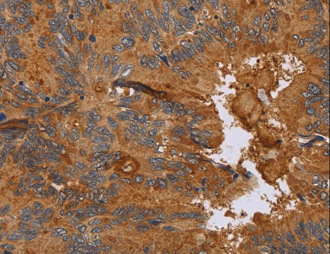 CCL21 / SLC Antibody - Immunohistochemistry of paraffin-embedded Human colon cancer using CCL21 Polyclonal Antibody at dilution of 1:40.