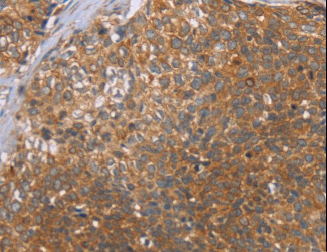 CCL21 / SLC Antibody - Immunohistochemistry of paraffin-embedded Human cervical cancer using CCL21 Polyclonal Antibody at dilution of 1:40.