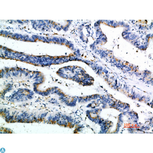 CCL21 / SLC Antibody - Immunohistochemical analysis of paraffin-embedded human-colon-cancer, antibody was diluted at 1:200.