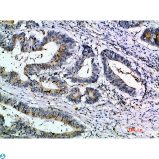 CCL21 / SLC Antibody - Immunohistochemical analysis of paraffin-embedded human-colon-cancer, antibody was diluted at 1:200.