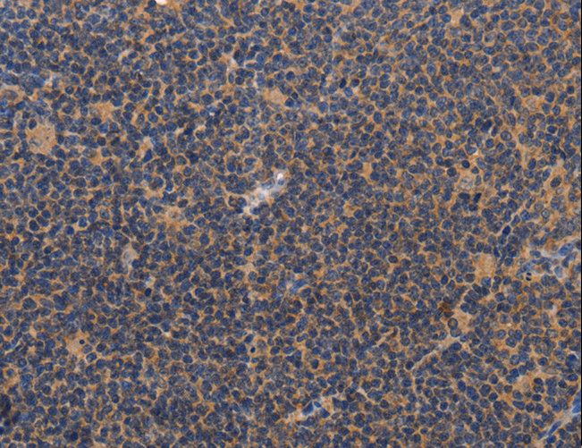 CCL23 / MIP3 Antibody - Immunohistochemistry of paraffin-embedded Human lymphoma using CCL23 Polyclonal Antibody at dilution of 1:50.