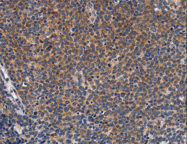 CCL23 / MIP3 Antibody - Immunohistochemistry of paraffin-embedded Human lung cancer using CCL23 Polyclonal Antibody at dilution of 1:50.