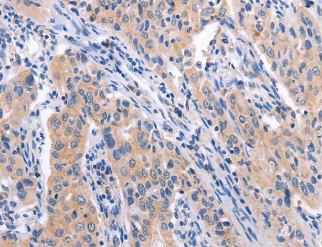 CCL23 / MIP3 Antibody - Immunohistochemistry of paraffin-embedded Human lung cancer using CCL23 Polyclonal Antibody at dilution of 1:50.
