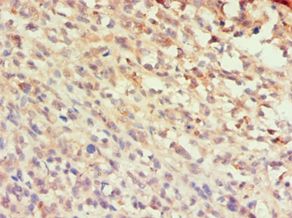 CCL25 / TECK Antibody - Immunohistochemistry of paraffin-embedded human melanoma using antibody at 1:100 dilution.