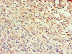 CCL25 / TECK Antibody - Immunohistochemistry of paraffin-embedded human melanoma using CCL25 Antibody at dilution of 1:100