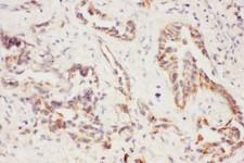 CCL26 / Eotaxin 3 Antibody - Eotaxin 3 antibody IHC-paraffin: Human Lung Cancer Tissue.